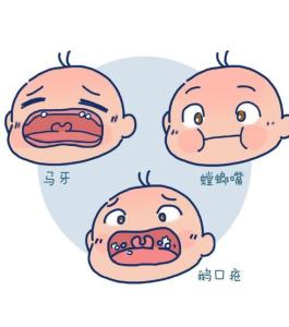 新生儿口腔