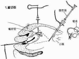 女性绝育手术示意图