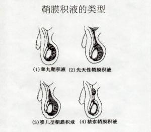 正常男子,随着胎儿时 睾丸下降,会 随带 二层腹膜进入阴囊,进入阴囊