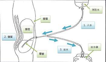 腹膜透析