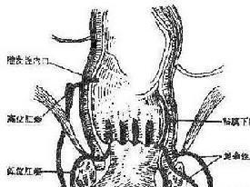 肛门瘘管