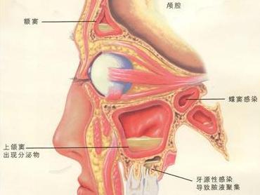 化脓性鼻窦炎