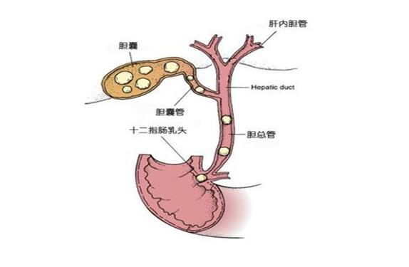 胆囊炎