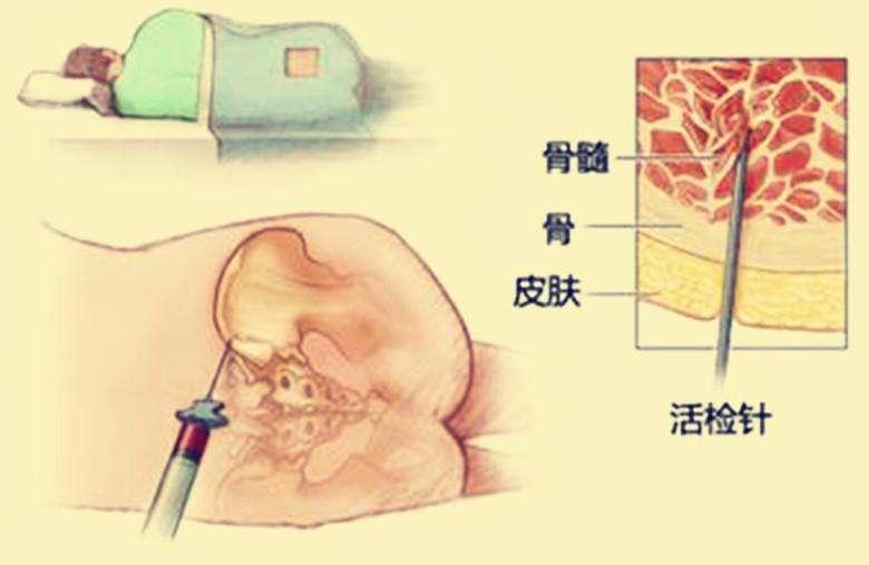 骨髓穿刺术