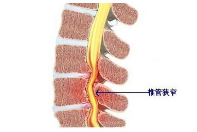 胸椎管狭窄症