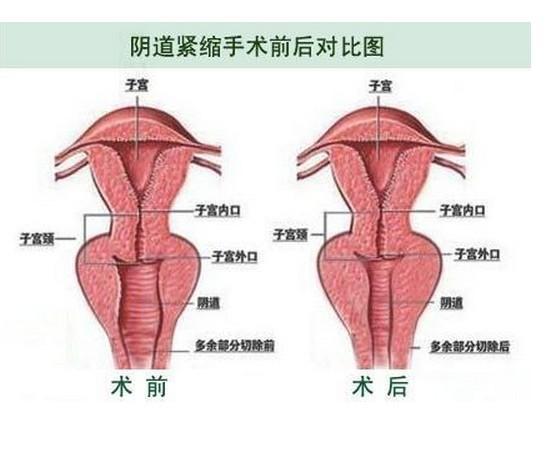 缩阴