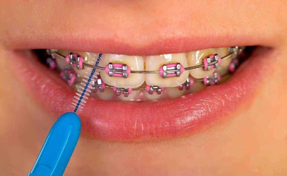 2,初戴牙套时,牙齿及口腔粘膜会有少许疼痛,一般一周后会适应.