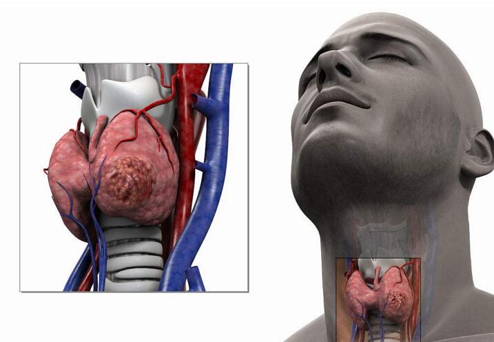 手术治疗:甲状腺癌的手术治疗包括甲状腺本身的手术,以及颈淋巴结的