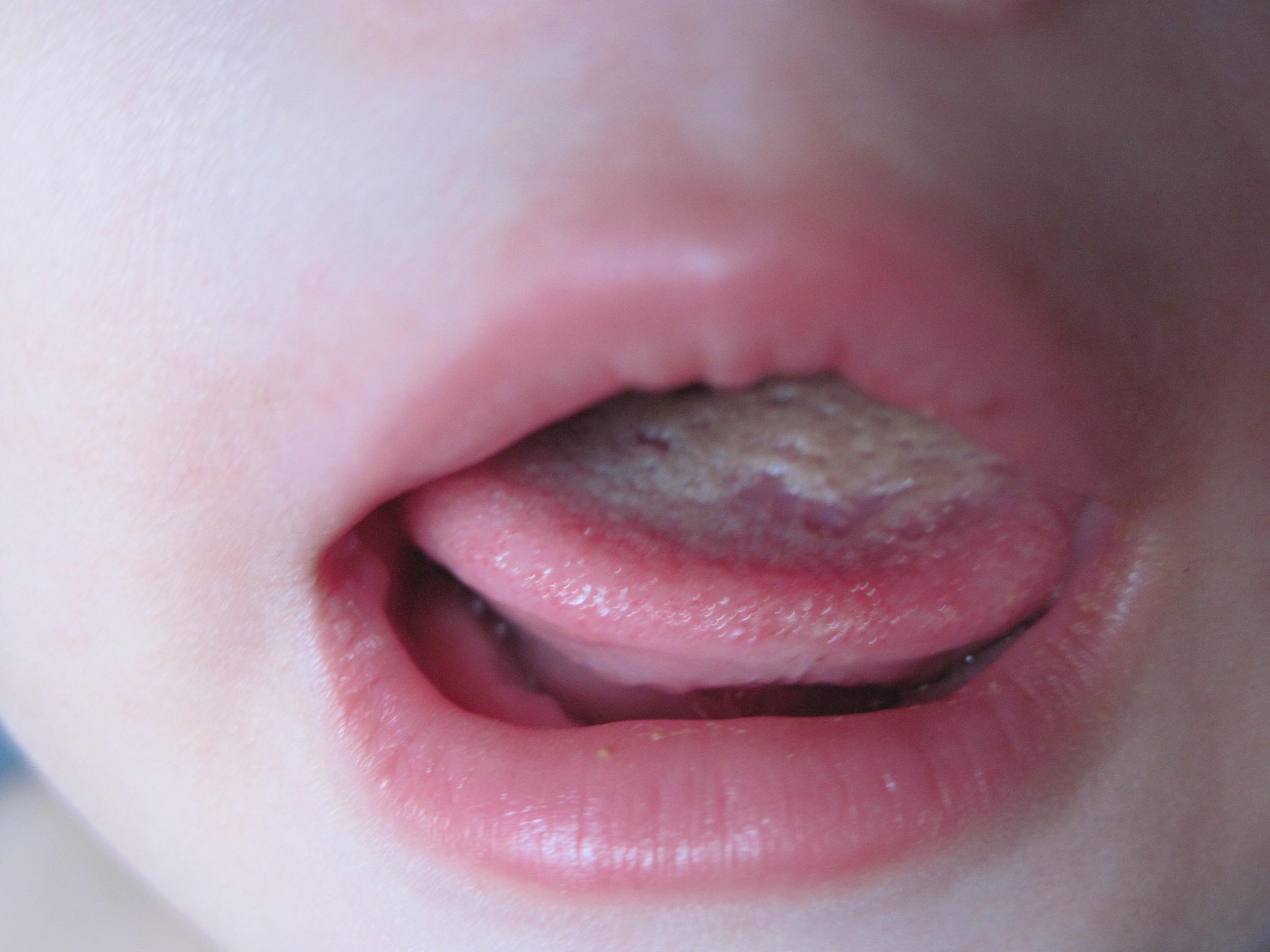 宝宝口腔里的白色分泌物是奶块还是“鹅口疮”？__小豆苗疫苗助手