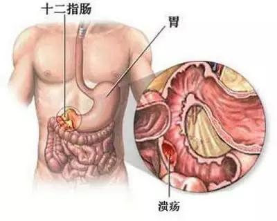 十二指肠溃疡