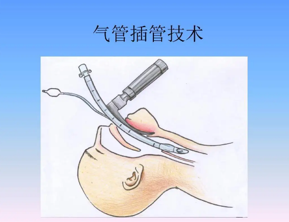 编辑2指征咽喉部生理解剖紧急气管插管技术已成为心肺复苏及伴有呼吸