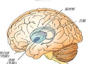 去脑强直,也叫去大脑强直,是因病变损害,使大脑与中脑和桥脑间的连系