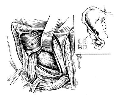 麦克威法腹股沟斜疝修补术