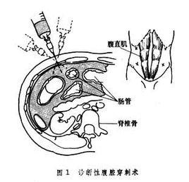 腹腔穿刺