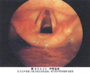 间接喉镜手术