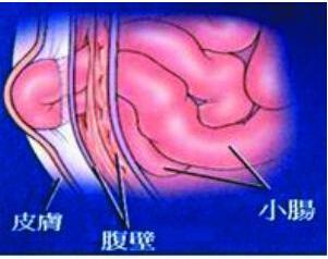 腹股沟疝