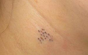 粉刺是什么样的一个状态 300