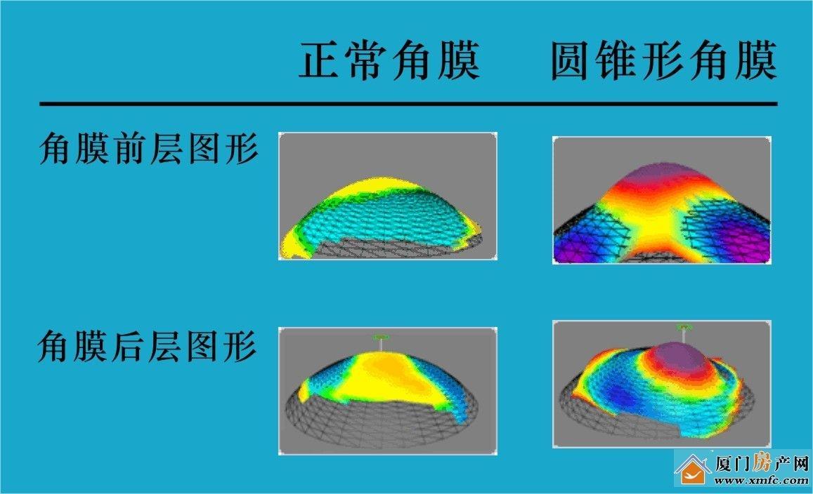 近视矫正手术的原理_从原理讲透彻 东莞全飞秒近视手术的利与弊(3)