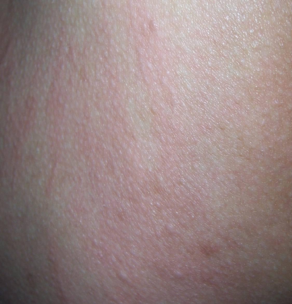 病毒性皮疹