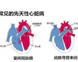 先天性心脏病右室双出口室间隔缺损肺动脉高压紧急求救右室双出口室