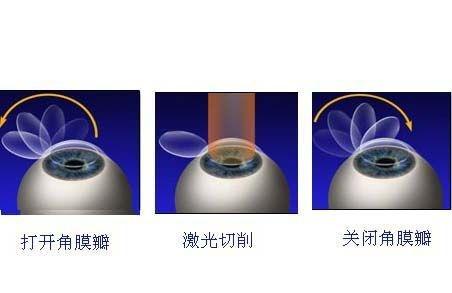 激光近视的原理_表情 谢立信院士 激光近视矫正术不能因噎废食 激光近视矫正术 圆锥 ... 表情