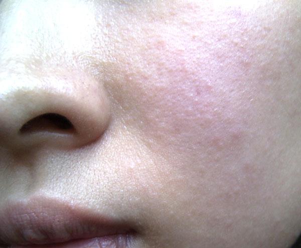 其他皮肤过敏症状还包括发痒,打喷嚏,流鼻水,泪眼,皮疹,气道阻塞,或如