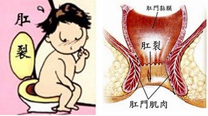 慢性肛裂