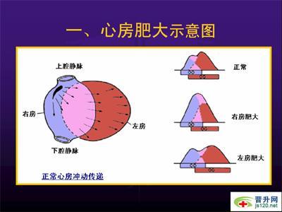 心室肥大