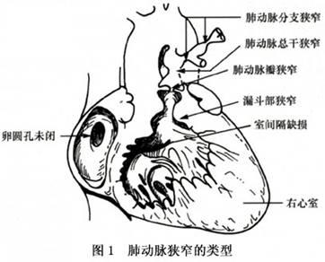 小儿单纯肺动脉口狭窄