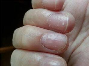 全部版本 历史版本  1,指甲变黑,指甲下有碎状斑点表明患有感染引起的