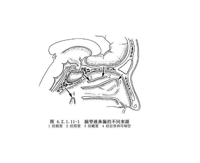 脑脊液鼻漏