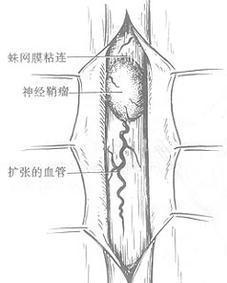 硬脊膜外脓肿