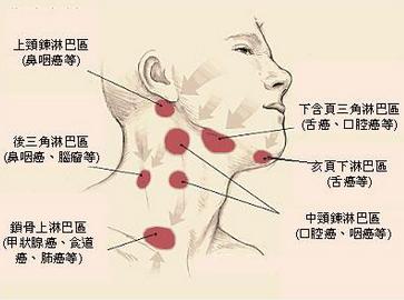 恶性淋巴瘤