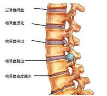 腰椎退行性变