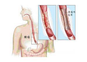 原发性食道癌