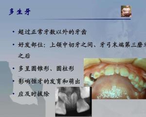 多生牙的大小和形态可能与它所属的磨牙,前磨牙或前牙组中的牙齿极为