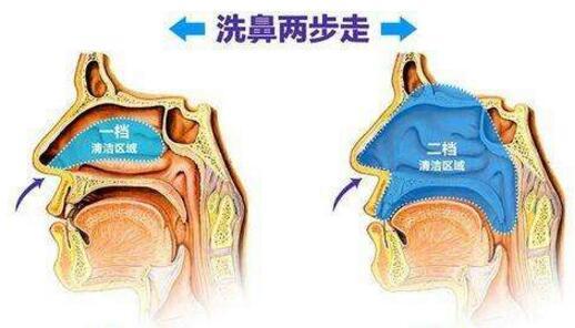 盐水洗鼻