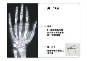 骨龄