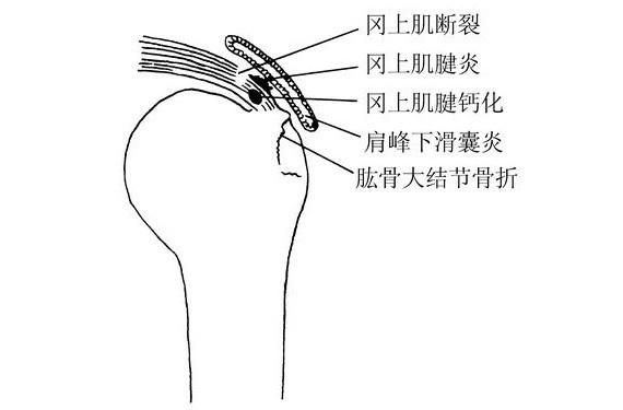 肩部撞击症