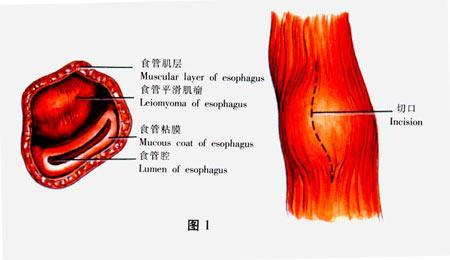 食管腐蚀性灼伤