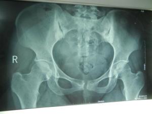 骶髂关节致密性骨炎