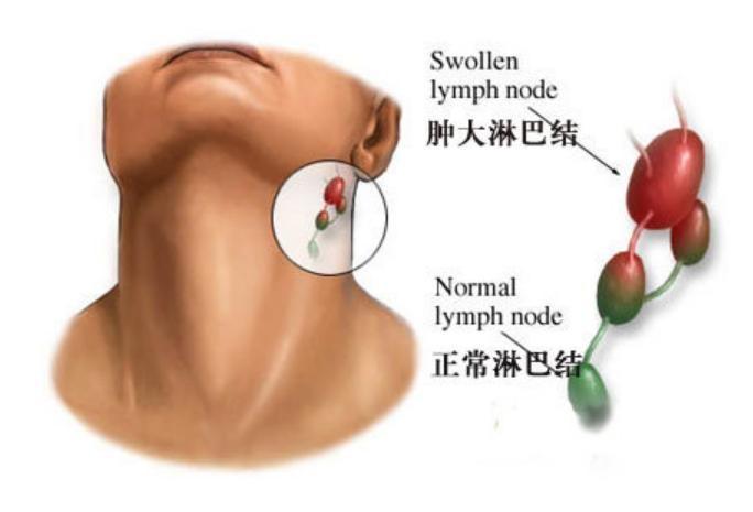 面颈部淋巴结炎