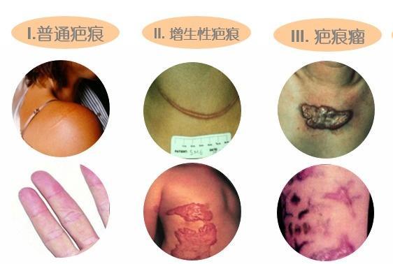 2,凸起性疤痕