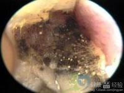 霉菌性外耳道炎