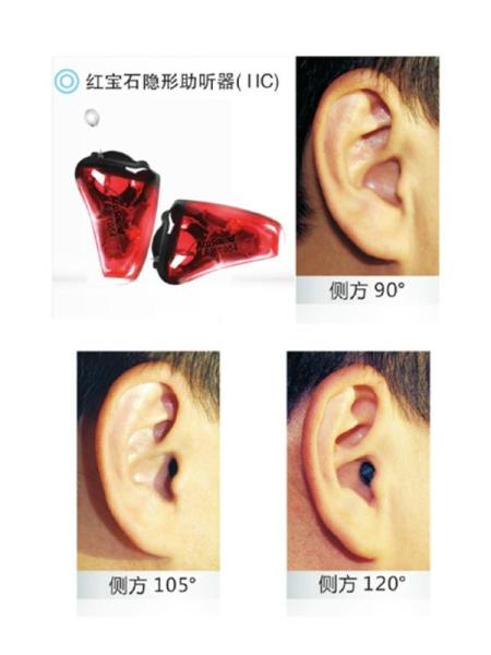 iic隐形助听器