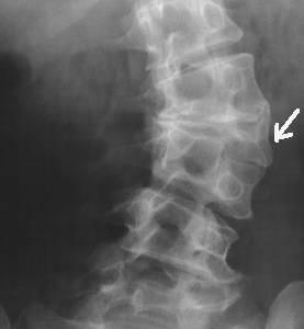 隐性脊柱裂是隐性椎管闭合不全中最为多见的一种,多见于腰骶