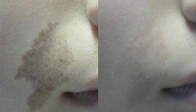 双生痣百科简介 800