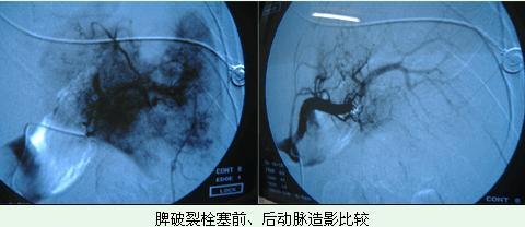 外伤性脾破裂