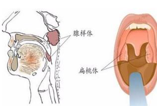 腺样体