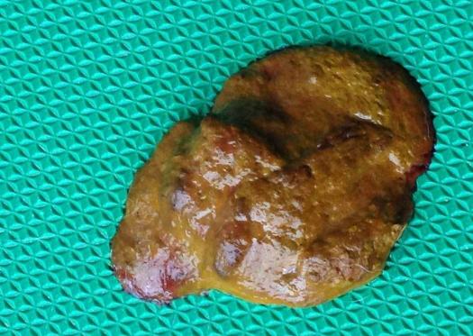 大便排出来什么颜色最好